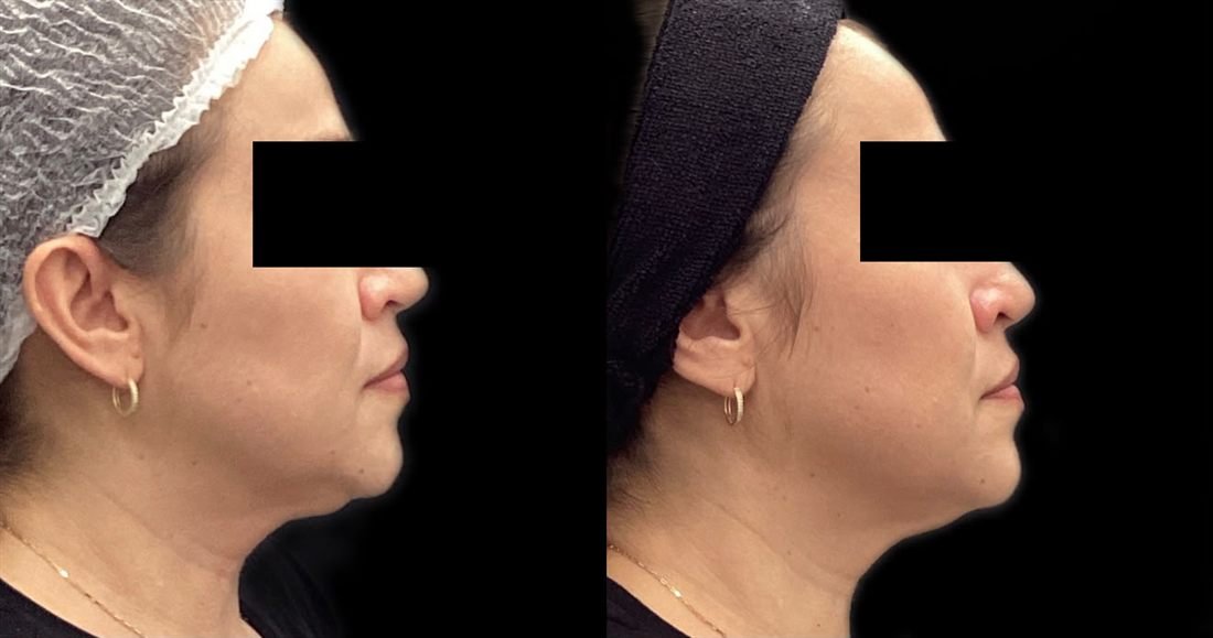 Antes e depois — papada e contorno da mandíbula com Linear Z