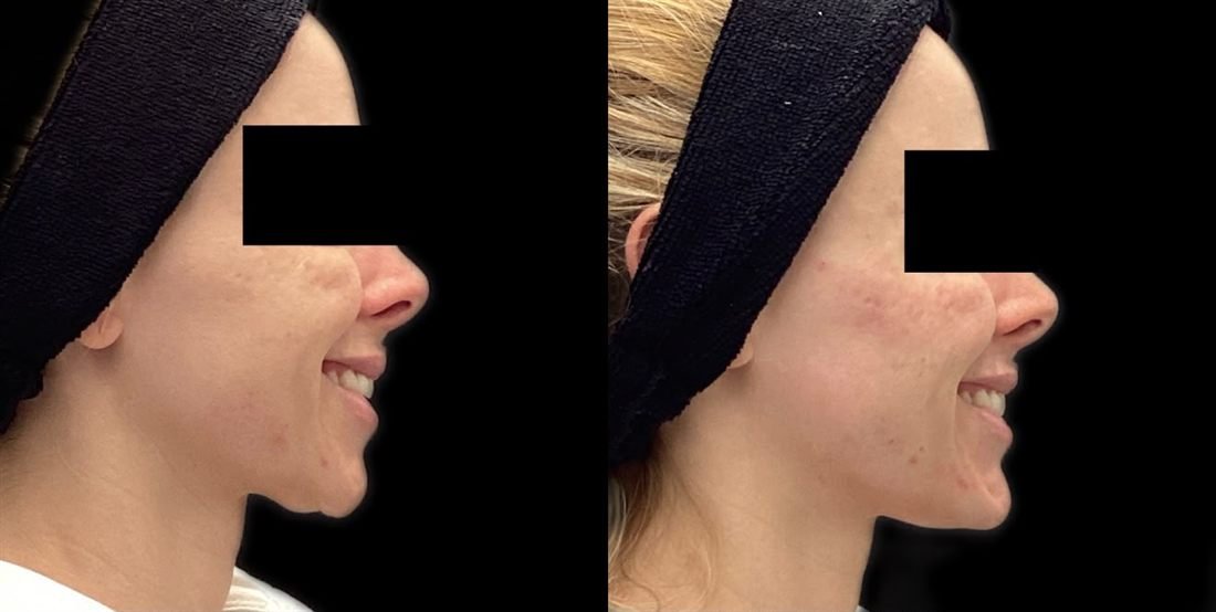 Antes e depois — contorno da mandíbula com Linear Z